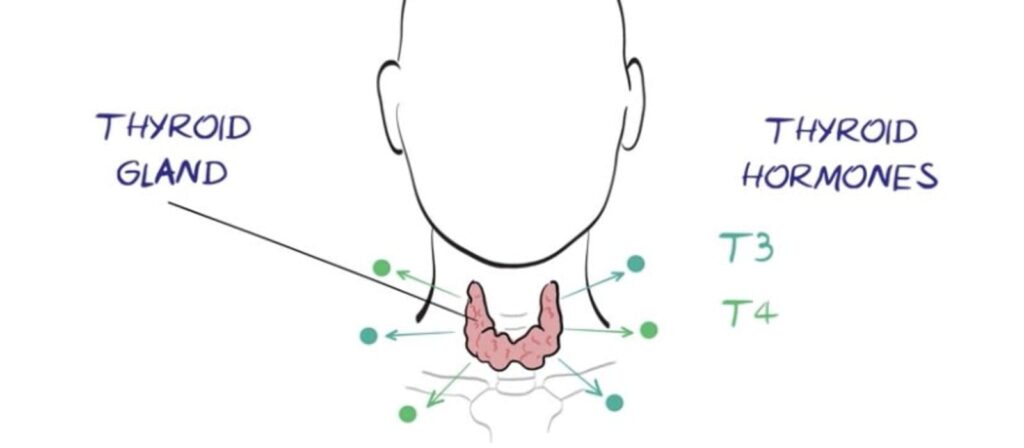 what causes fibromyalgia - hypothyroidism